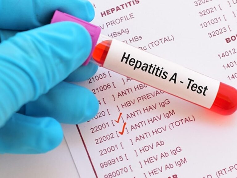 Hepatitis A