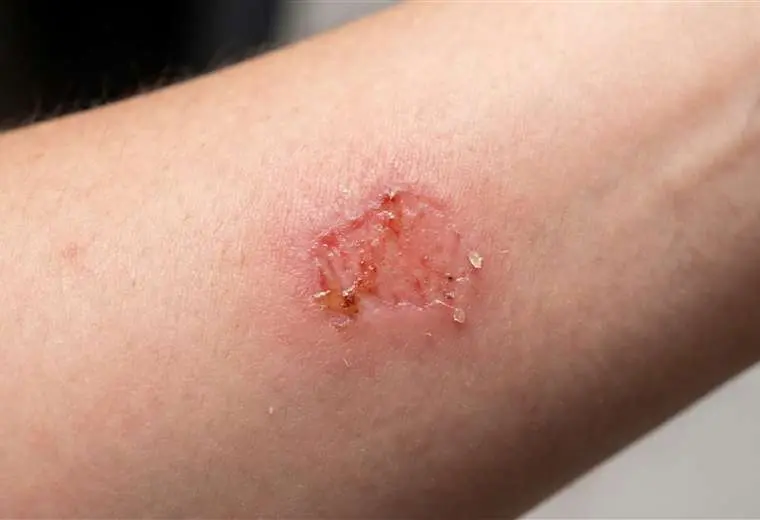 Leishmaniasis Papalomoyo